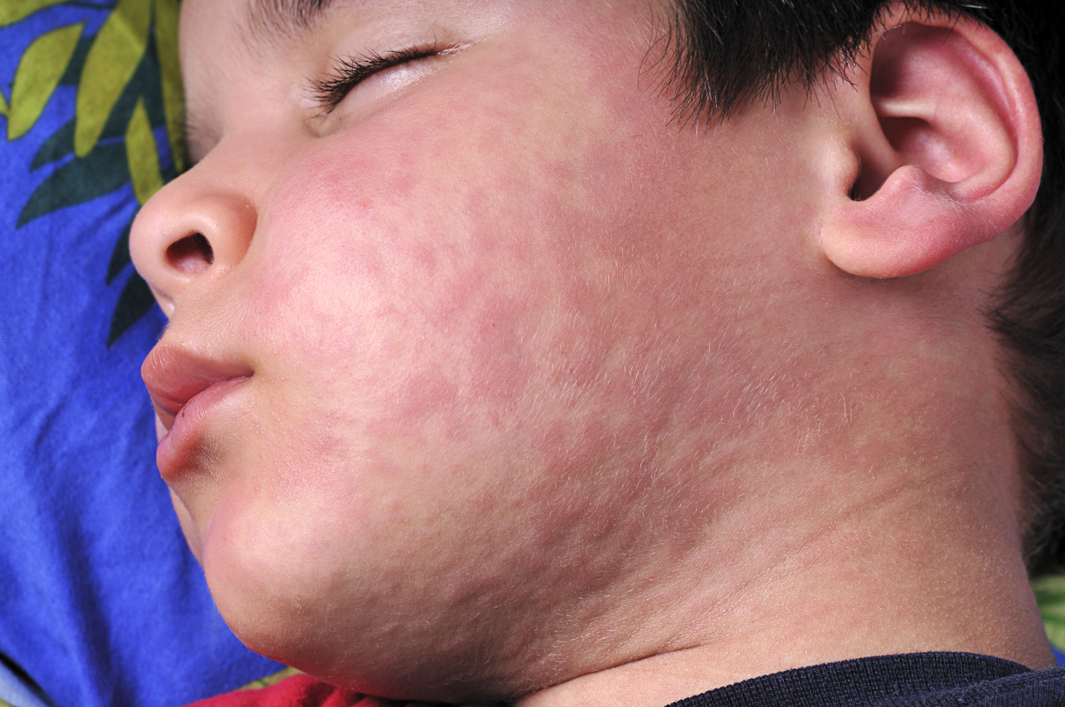 Image of child with Measles