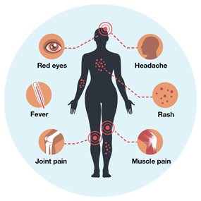 Image of symptoms of Zika